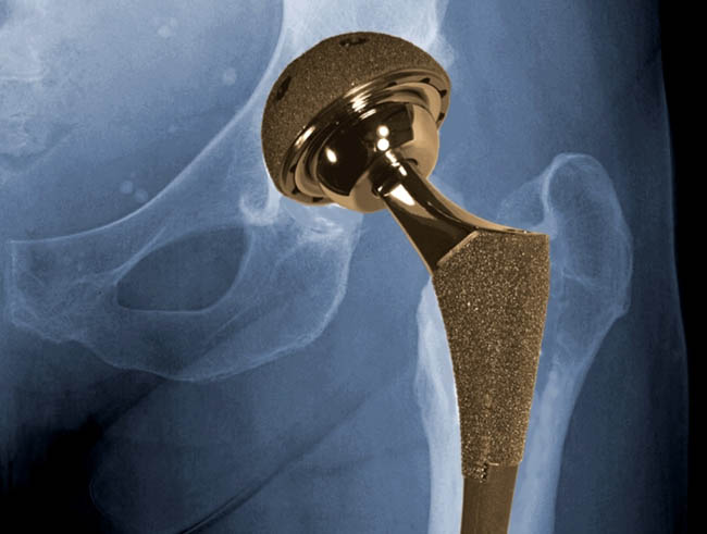 Hip Replacement Devices