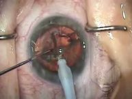 Modern Cataract Surgery is Effective and Minimally Evasive