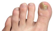Dangers of Oral Treatments for Toenail Fungus