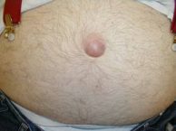 Advice For Those Who Suspect An Umbilical Hernia