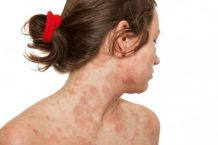 Treatment of Acne for Those Suffering From Eczema